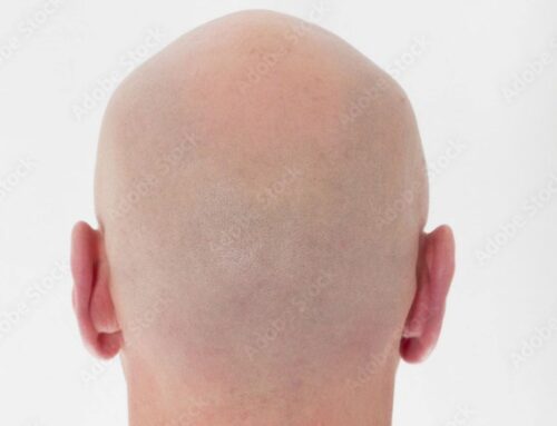 When a “Bald Joke” Stops Being Funny